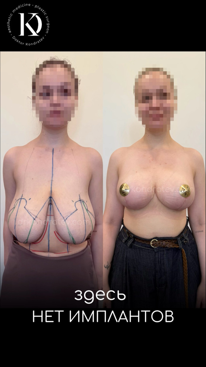 Gigantomastia, breast size 8 - 18+, My, Surgery, Doctors, The patients, Hospital, Video, Vertical video, Short videos, Longpost, NSFW, 