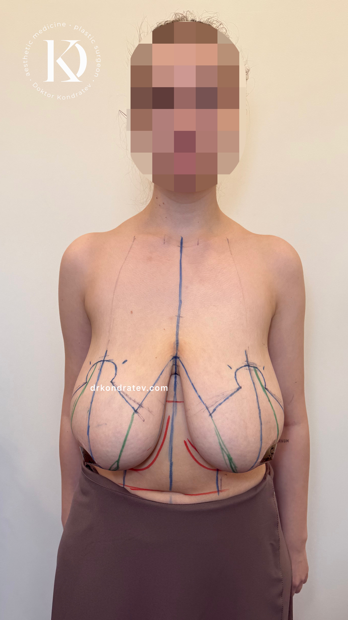 Gigantomastia, breast size 8 - 18+, My, Surgery, Doctors, The patients, Hospital, Video, Vertical video, Short videos, Longpost, NSFW, 