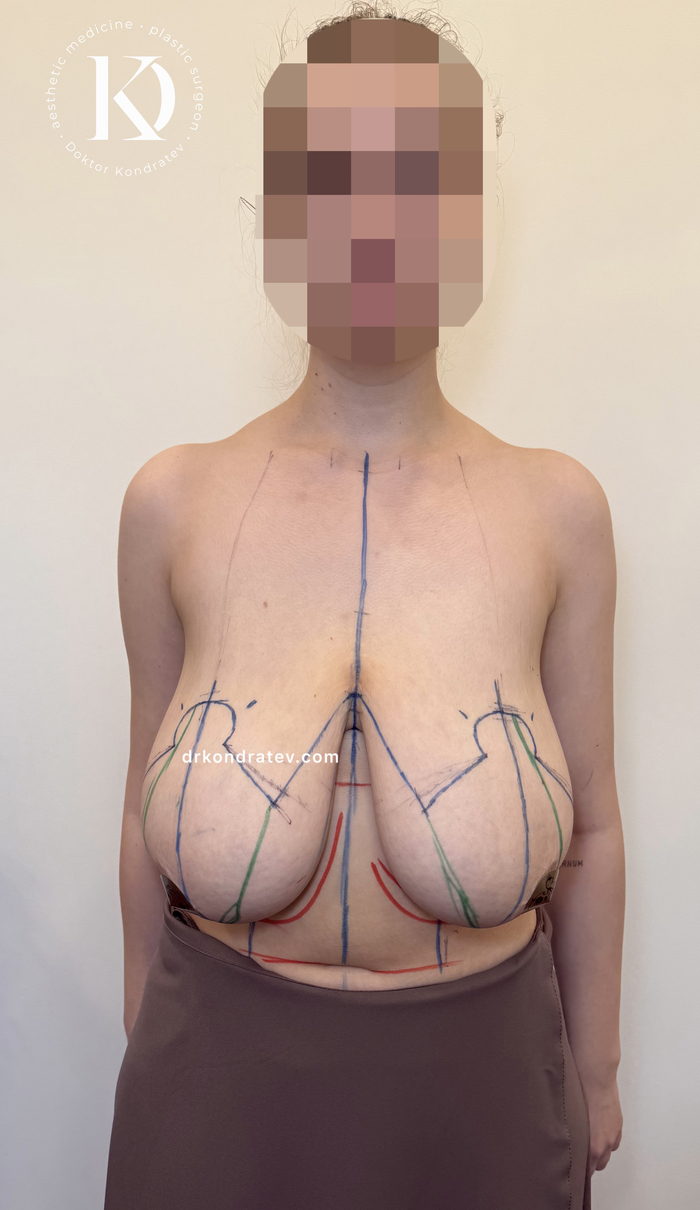Gigantomastia, breast size 8 - 18+, My, Surgery, Doctors, The patients, Hospital, Video, Vertical video, Short videos, Longpost, NSFW, 